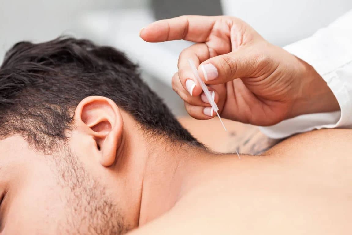 what is acupuncture – top of back acupuncture setting